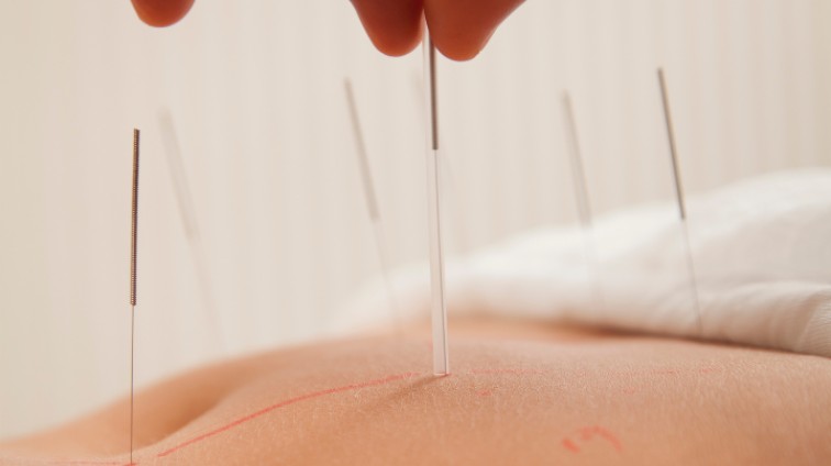 accupuncture (1)